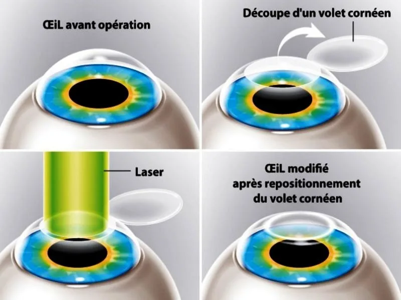 Schéma des 4 étapes du LASIK : œil avant opération, découpe du volet cornéen, remodelage au laser, repositionnement du volet cornéen