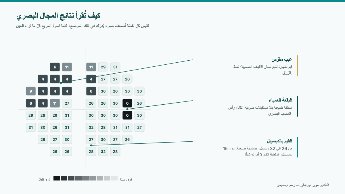 تقرير مطبوع لفحص المجال البصري يُظهر خريطة حساسية الشبكية