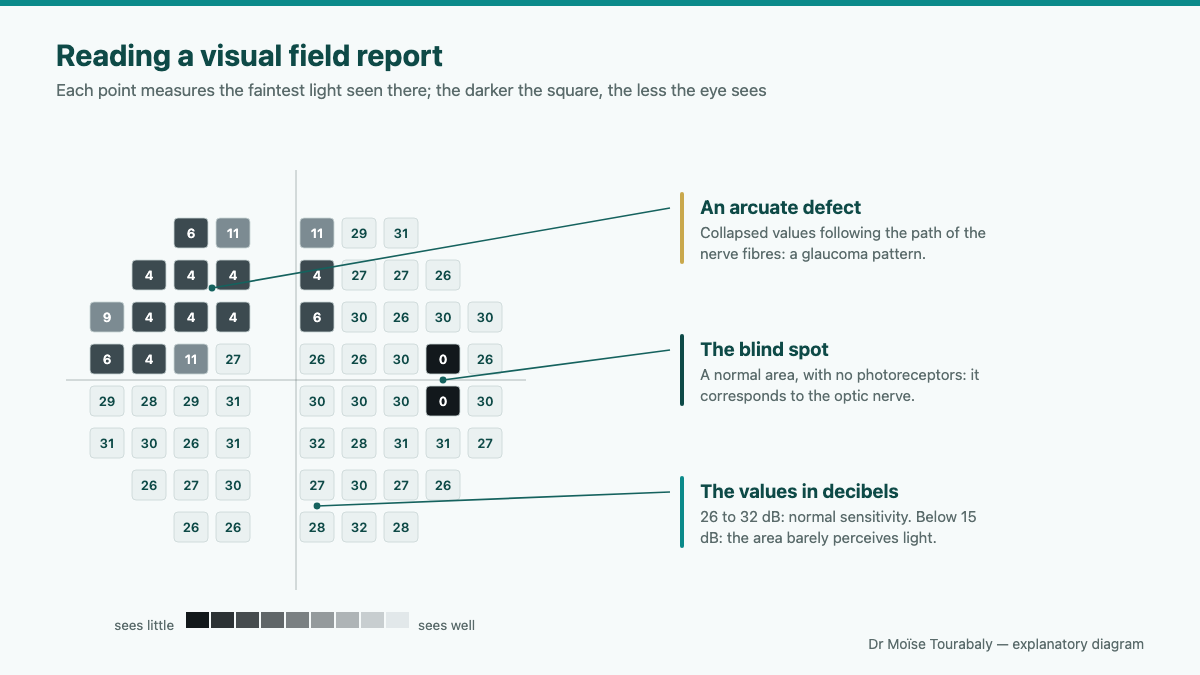Printed report of a visual field test showing the map of retinal sensitivity
