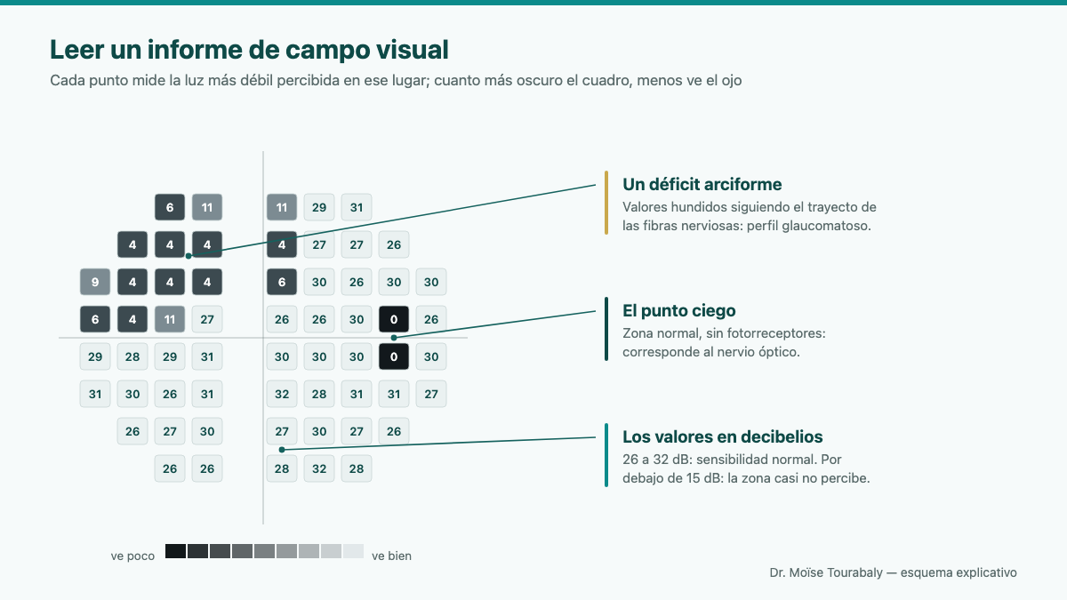 Informe impreso de un examen del campo visual que muestra la cartografía de la sensibilidad retiniana