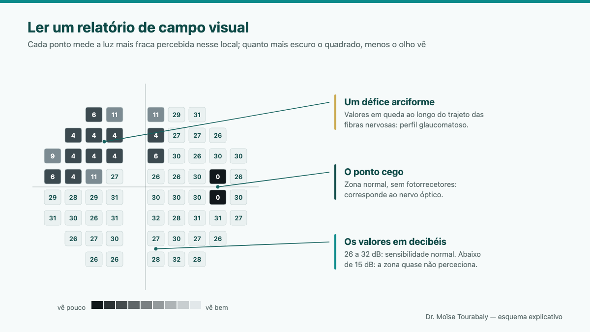 Impressão de um exame do campo visual mostrando a cartografia da sensibilidade retiniana