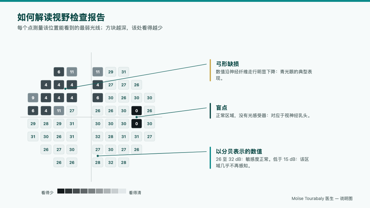 视野检查的打印报告,显示视网膜敏感度地图