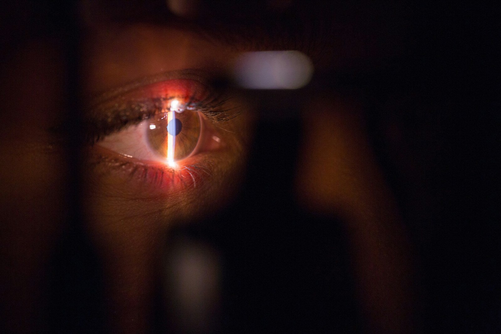 Sezione ottica della cornea alla lampada a fessura, la fessura luminosa che attraversa la superficie oculare